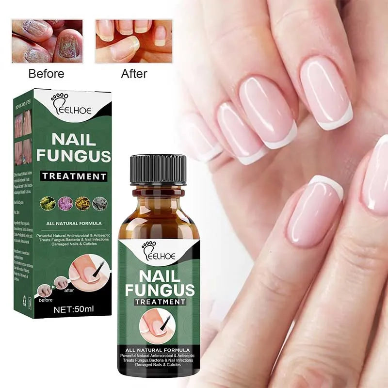 Nail Fungus Treatment Serum 10ml (Buy 1 Get 1 Free)