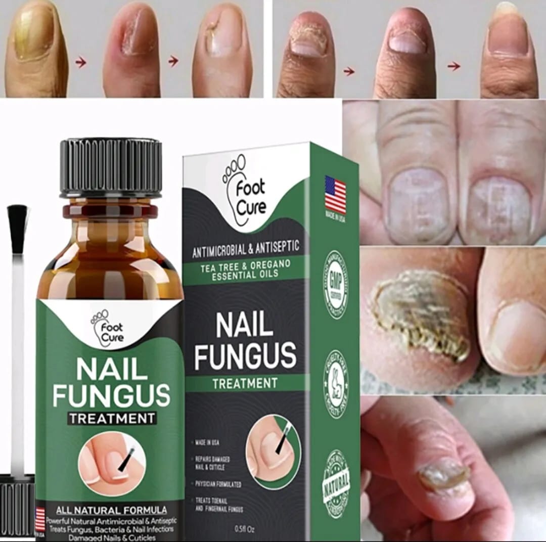Nail Fungus Treatment Serum 10ml (Buy 1 Get 1 Free)