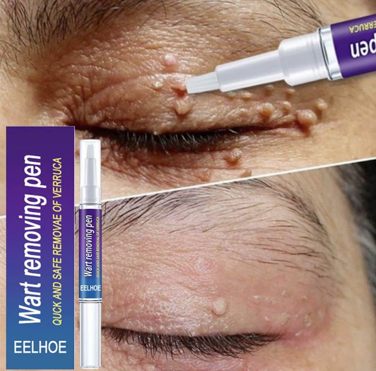 Warts & Moles Remover Pen (GUARNTEED RESULT)