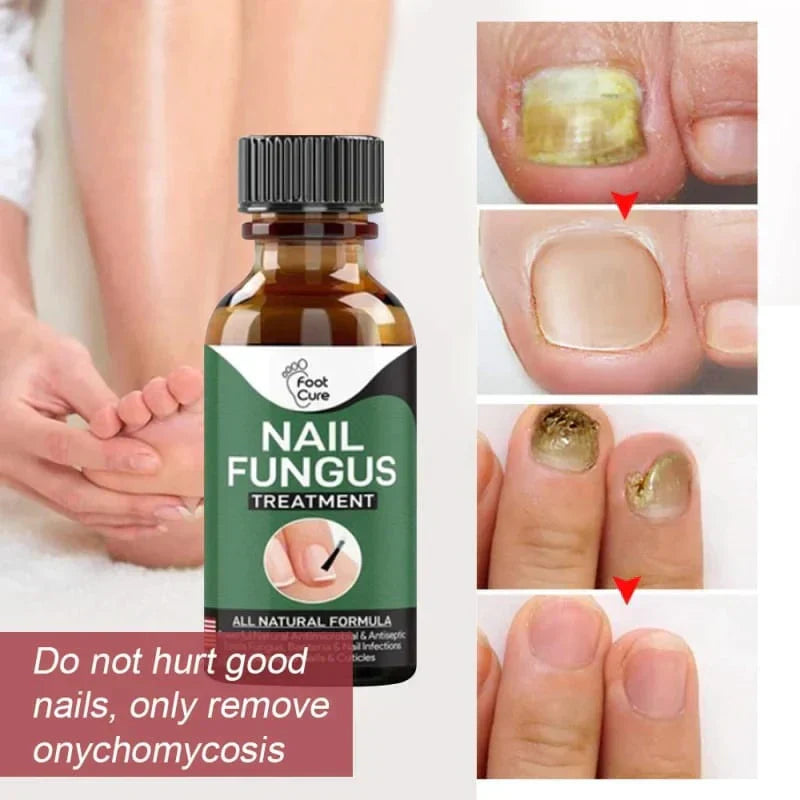 Nail Fungus Treatment Serum 10ml (Buy 1 Get 1 Free)
